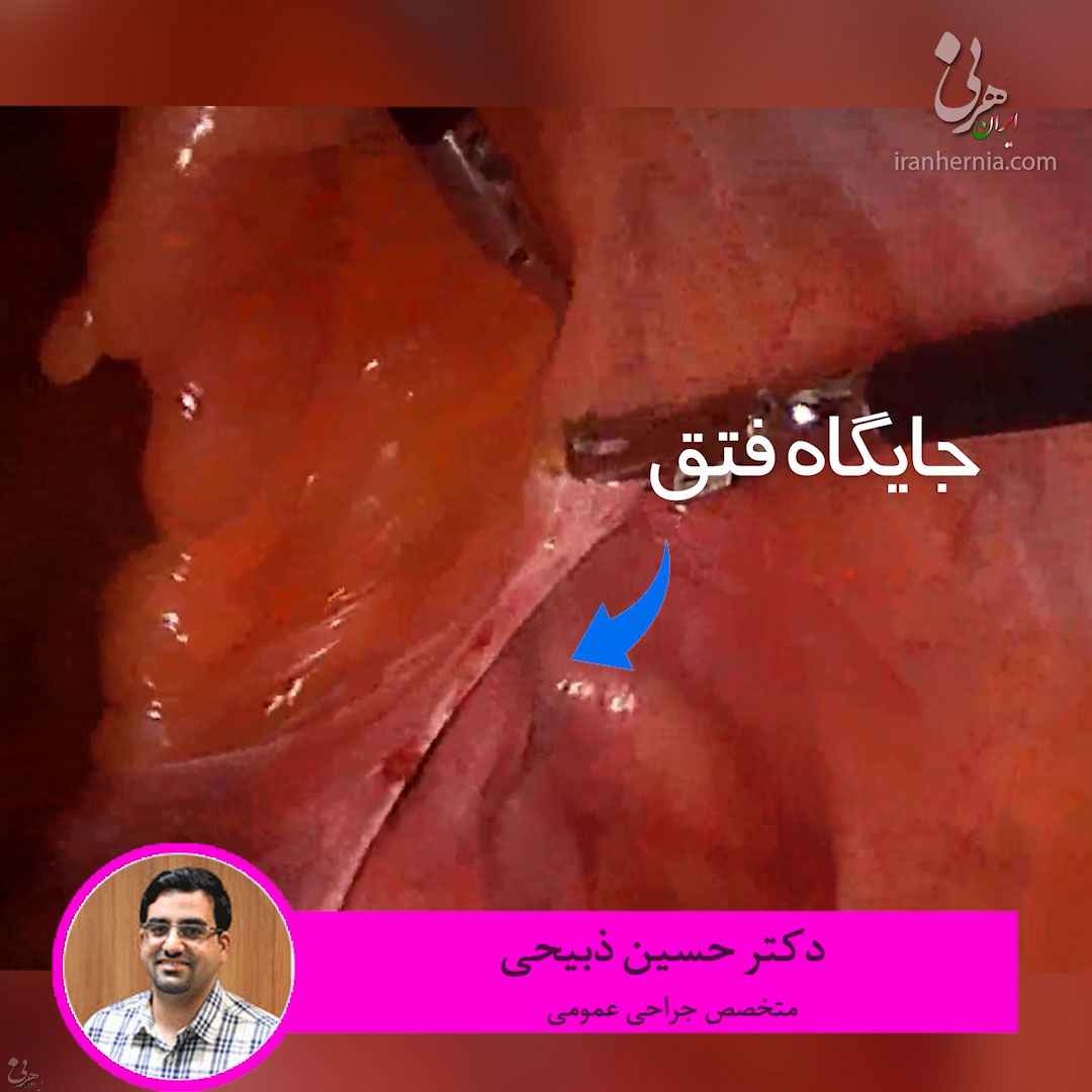 فیلم جراحی فتق به روش لاپاروسکوپی