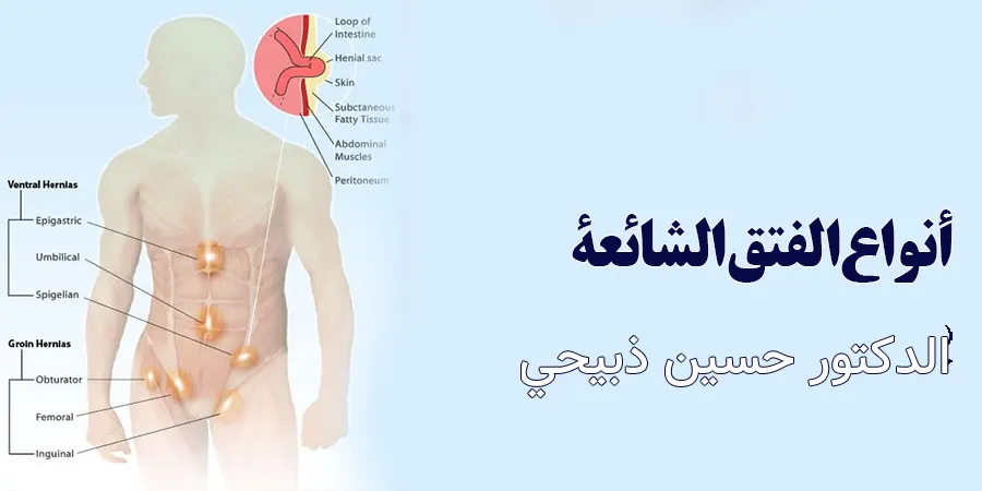 كيف أعرف أني مصاب بالفتق؟