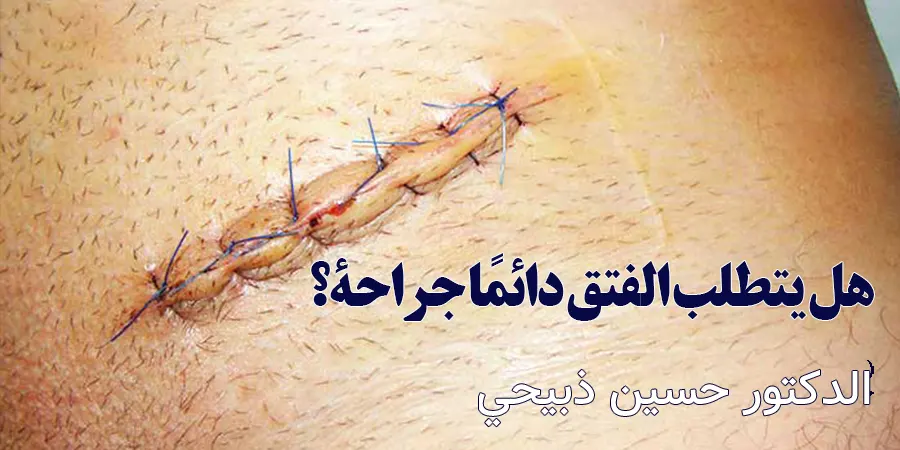 هل يتطلب الفتق دائمًا جراحة؟