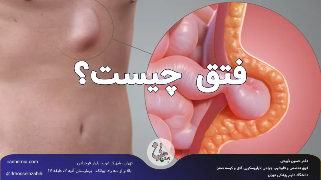 فتق چیست؟  علائم، خطرات و راهنمای درمان فتق شکم و کشاله ران