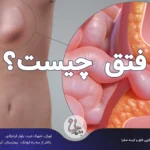 فتق چیست؟  علائم، خطرات و راهنمای درمان فتق شکم و کشاله ران
