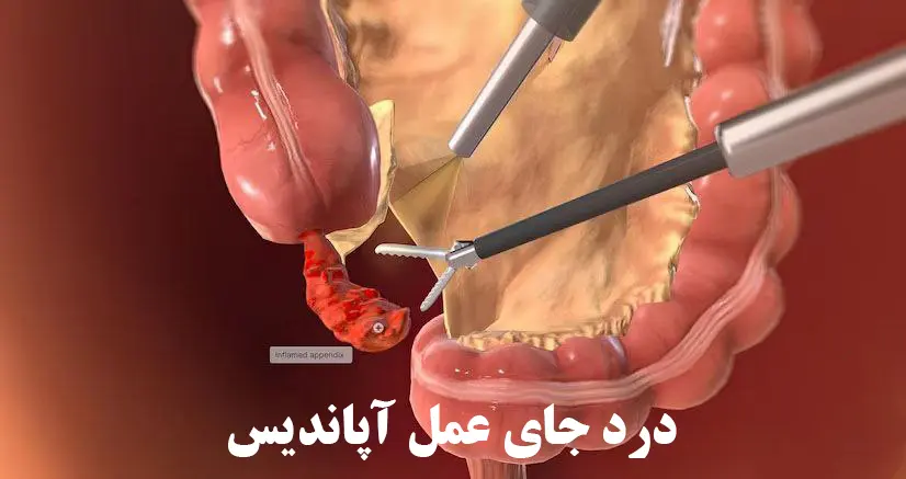 درد جای عمل آپاندیس