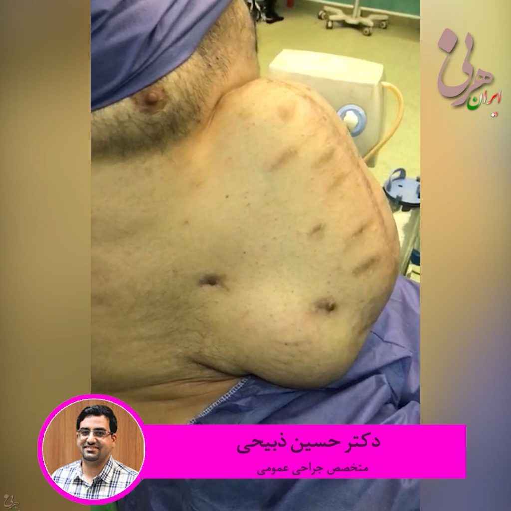 آقای ۴۳ ساله که به دلایل مختلف چند بار تحت عمل جراحی شکم قرار گرفته و فتق بسیار بزرگ شکمی داشته است