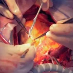 جراحی فتق کشاله ران : باز یا لاپاروسکوپی