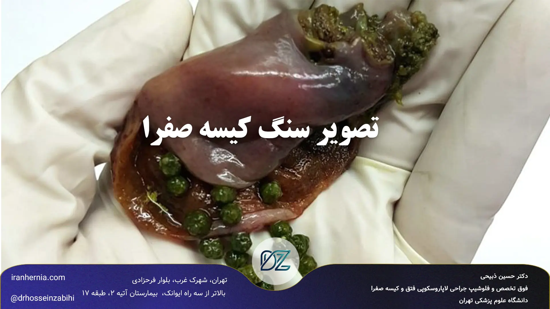 تصویر سنگ کیسه صفرا