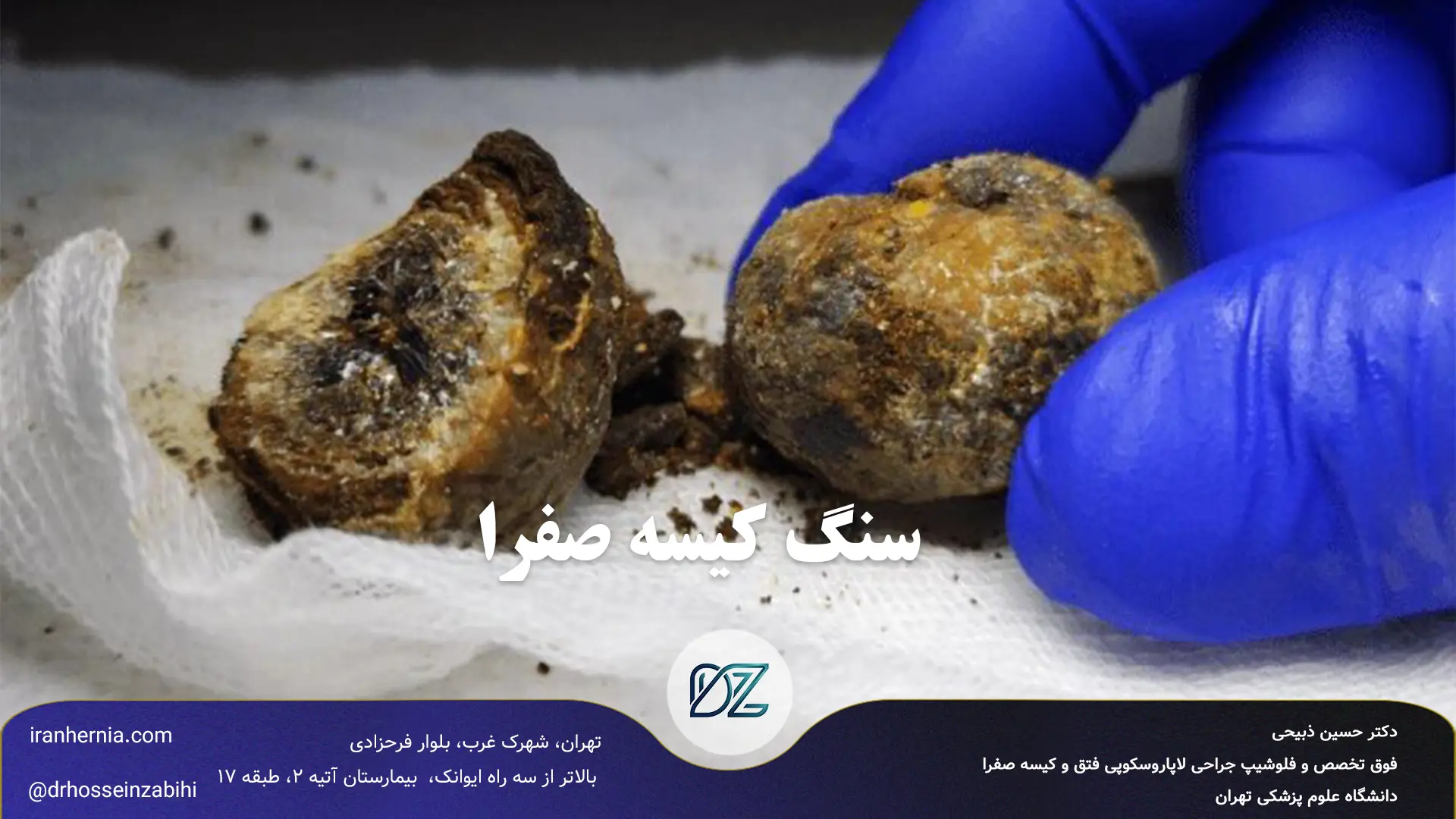 سنگ کیسه صفرا