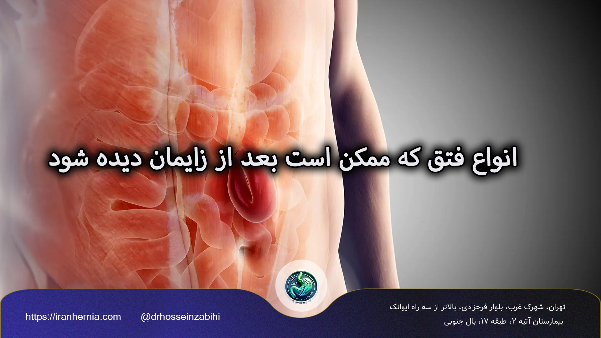 انواع فتق که ممکن است بعد از زایمان دیده شود